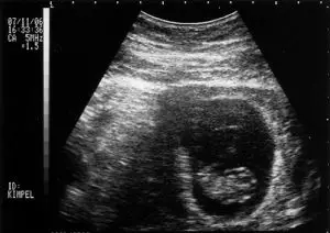 what is a sonogram. sonogram example