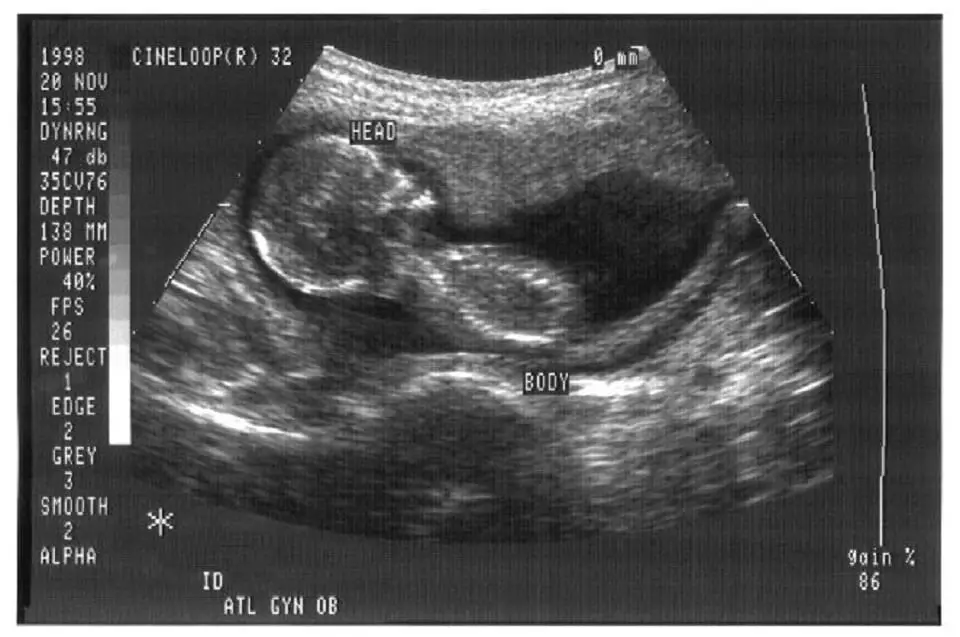 What is a sonogram? Image is a sonogram of a four month old fetus